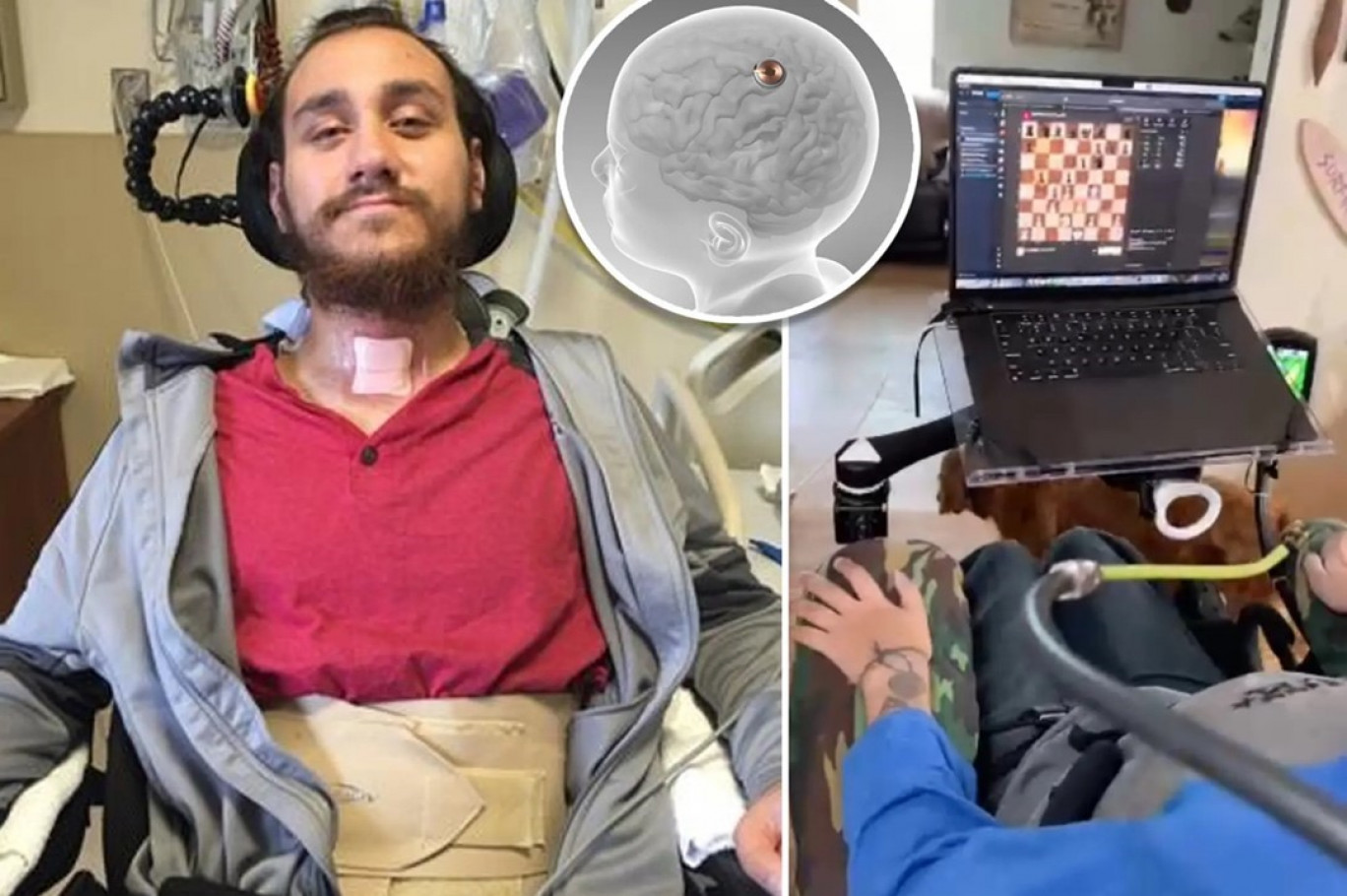 Noland, il primo paziente Neuralink con un chip nel cervello: “Legge i pensieri, so quali sono i rischi